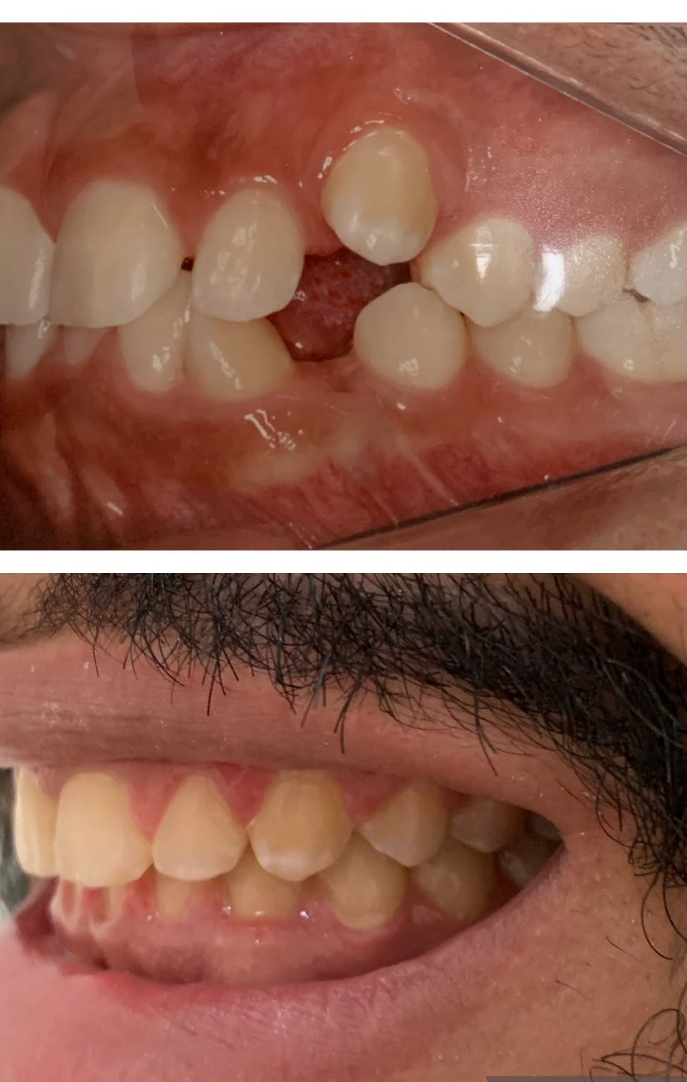 Antes e depois da ortodontia, foto 1